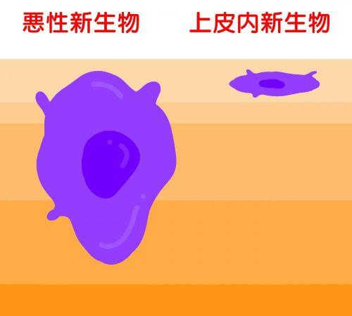 がん悪性新生物（悪性腫瘍）と上皮内がん（上皮内新生物）の違い