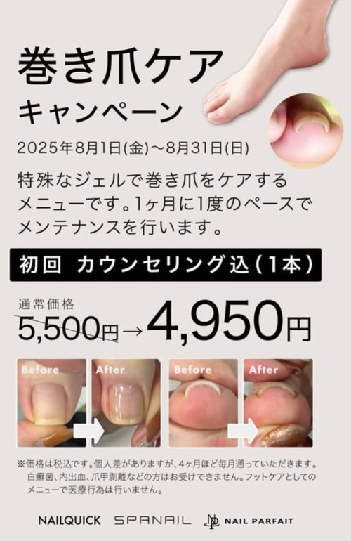 巻き爪ケアキャンペーン